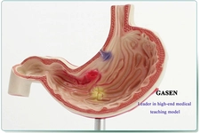 Gastrik Ülser Belirtileri ve Tedavisi